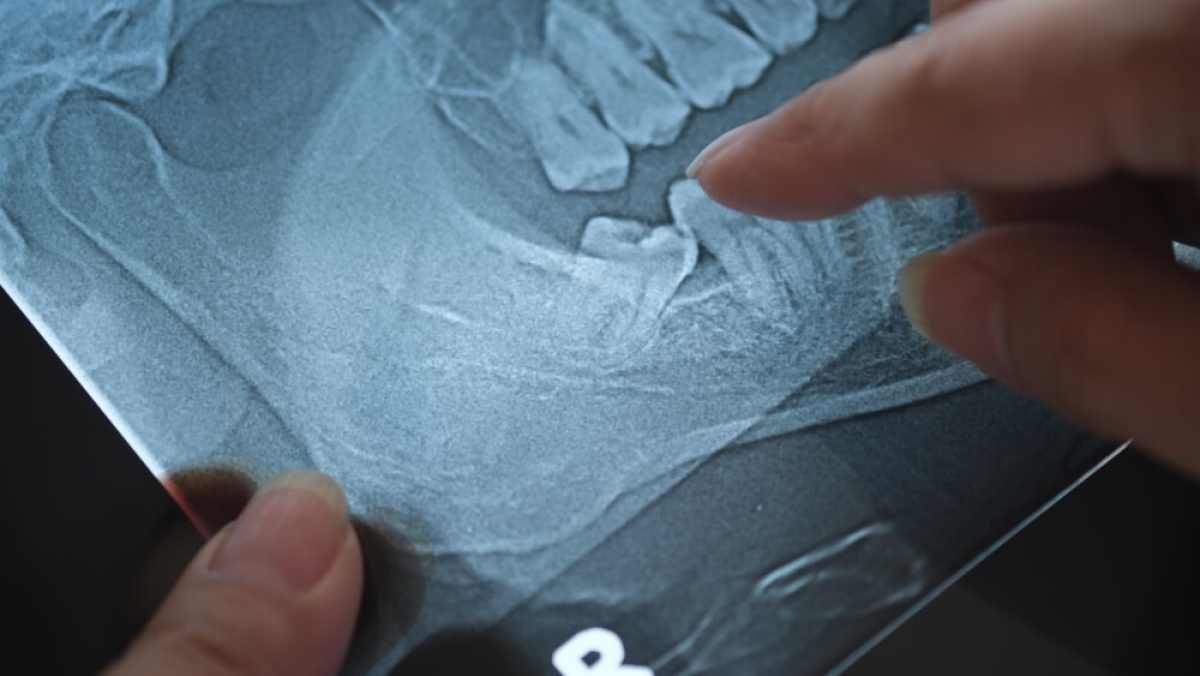 Usunięcie ósemki - kiedy dentysta kieruje pacjenta do chirurga stomatologicznego?