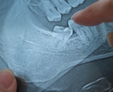 Usunięcie ósemki - kiedy dentysta kieruje pacjenta do chirurga stomatologicznego?