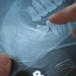 Usunięcie ósemki - kiedy dentysta kieruje pacjenta do chirurga stomatologicznego?